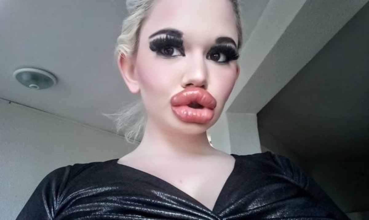 Самые большие в мире губы: как выглядит девушка после 20 операций