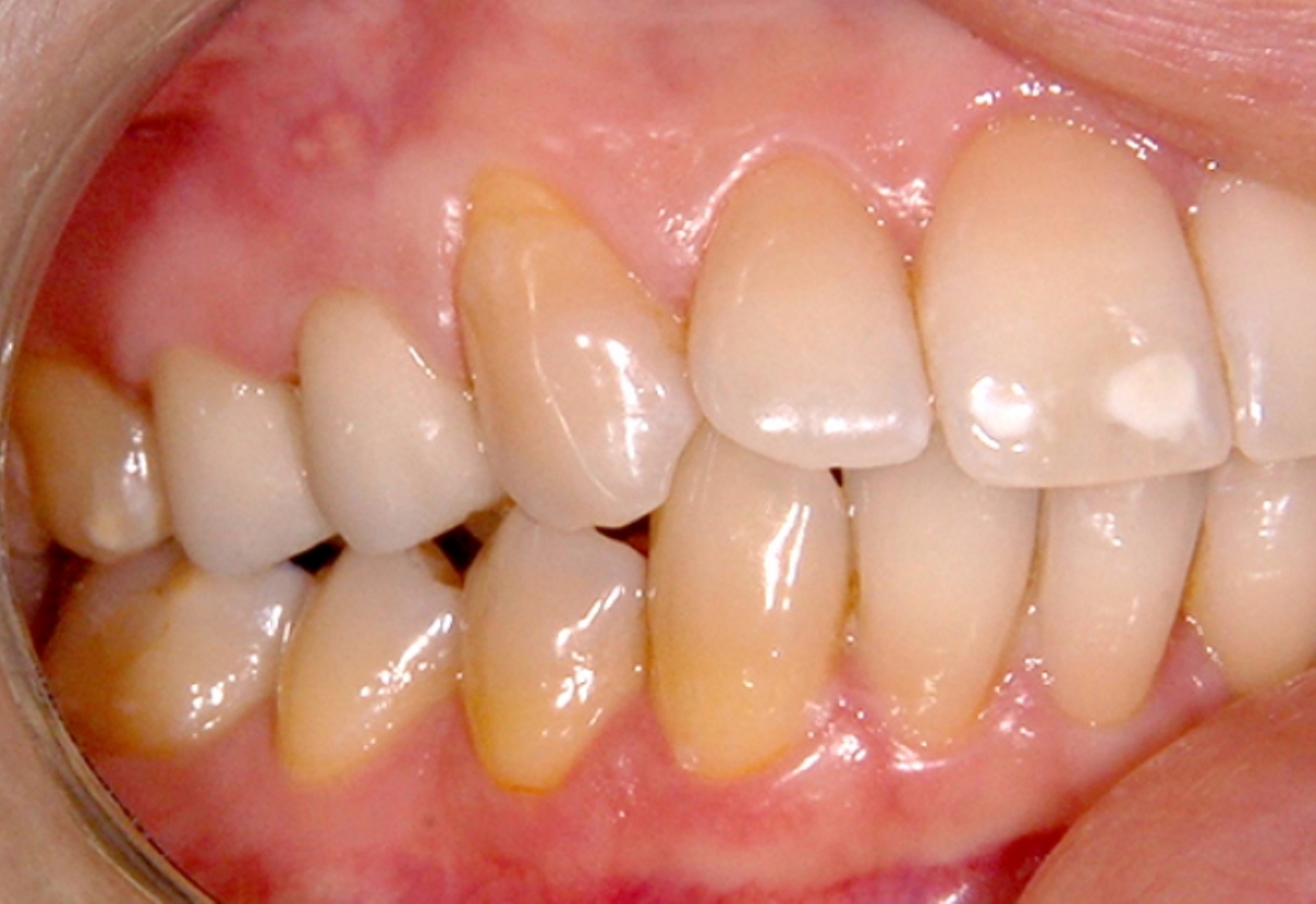 Стоматологи научились заживлять зубную эмаль без бормашинки