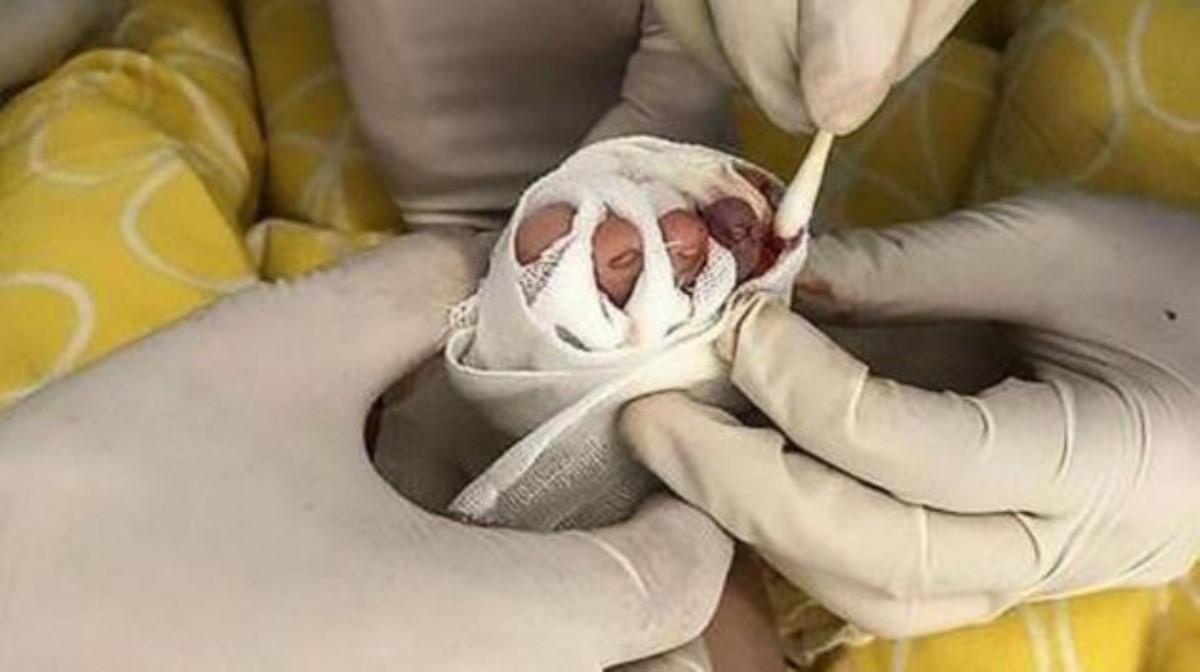 Младенцу грозит ампутация пальца из-за маминого волоса