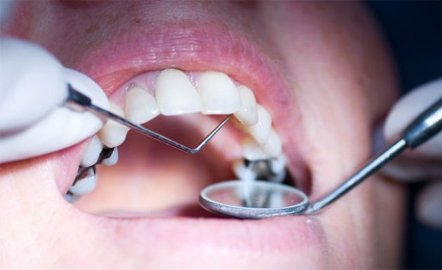 Стоматологи объяснили от чего выпадают пломбы
