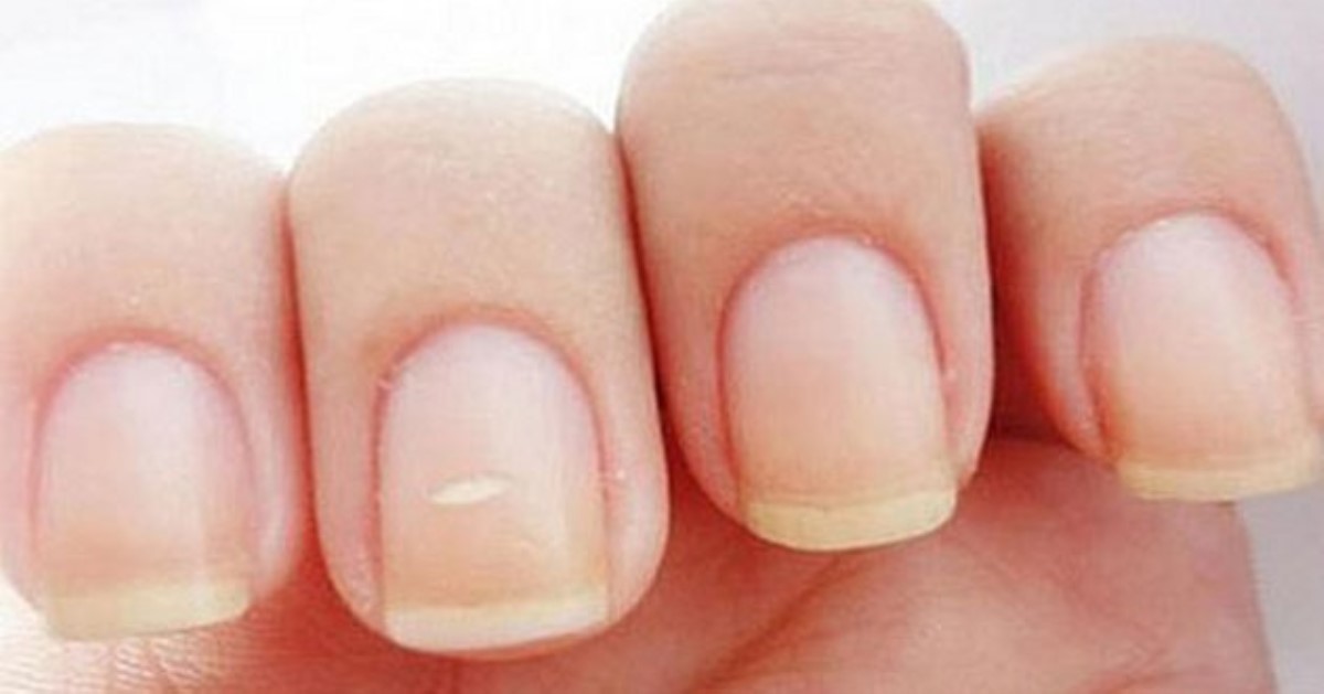 Не стригите грибковые ногти: есть простой и дешевый способ справиться с болезнью
