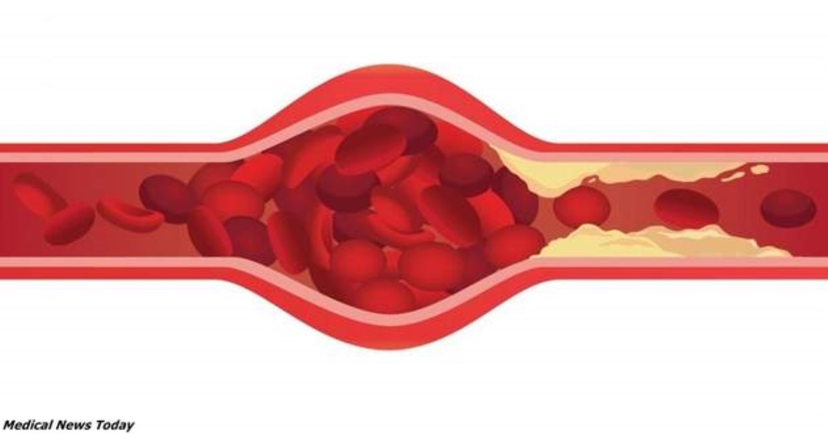 5 тревожных признаков, что ваши артерии уже забиты бляшками