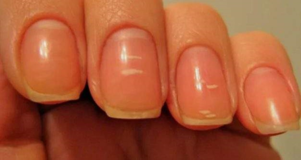 Белые пятна на ногтях расскажут о болезнях