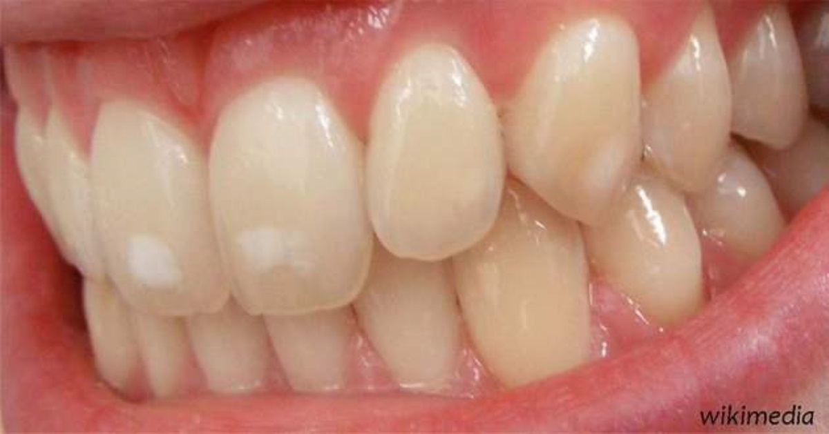 О чём говорят белые пятна на зубах?