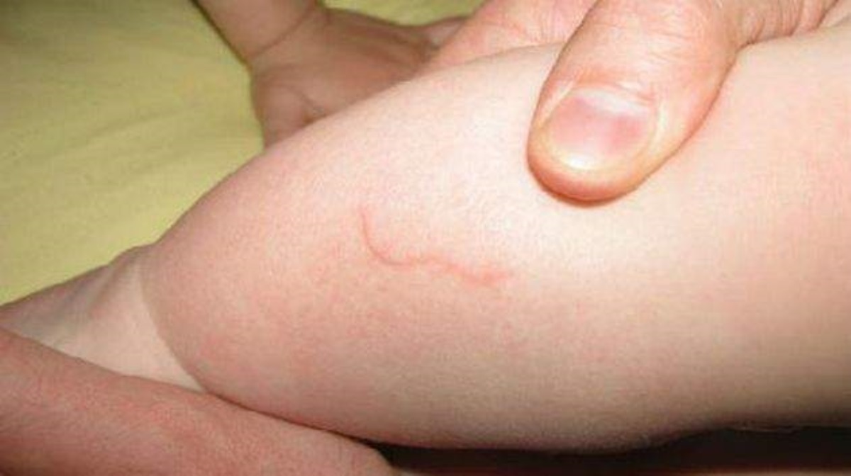 17-сантиметровые черви под кожей: в Украине зафиксировано опасное заболевание