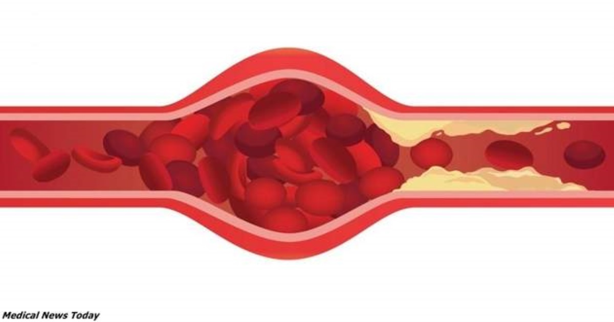 Можно не бояться инсульта: чистим сосуды правильно