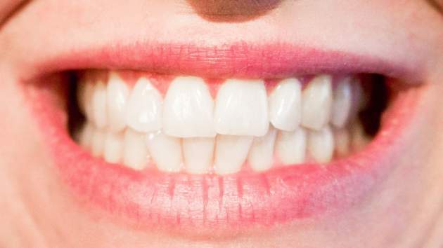 Проверено на практике: как в домашних условиях избавиться от кариеса