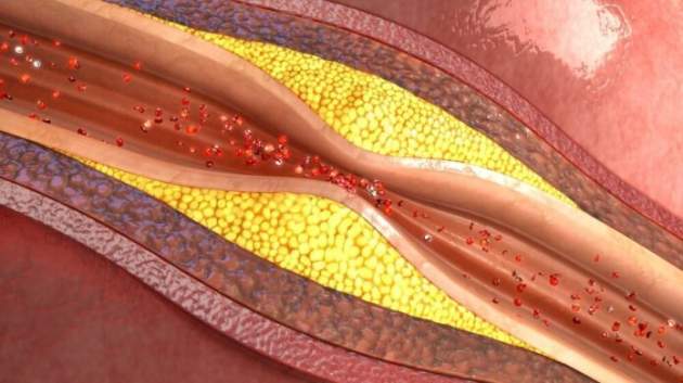 Врачи назвали главные признаки забитых артерий
