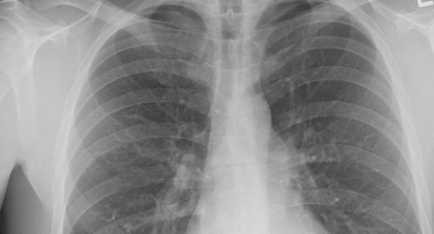 7 ранних симптомов туберкулёза, которые нельзя пропустить