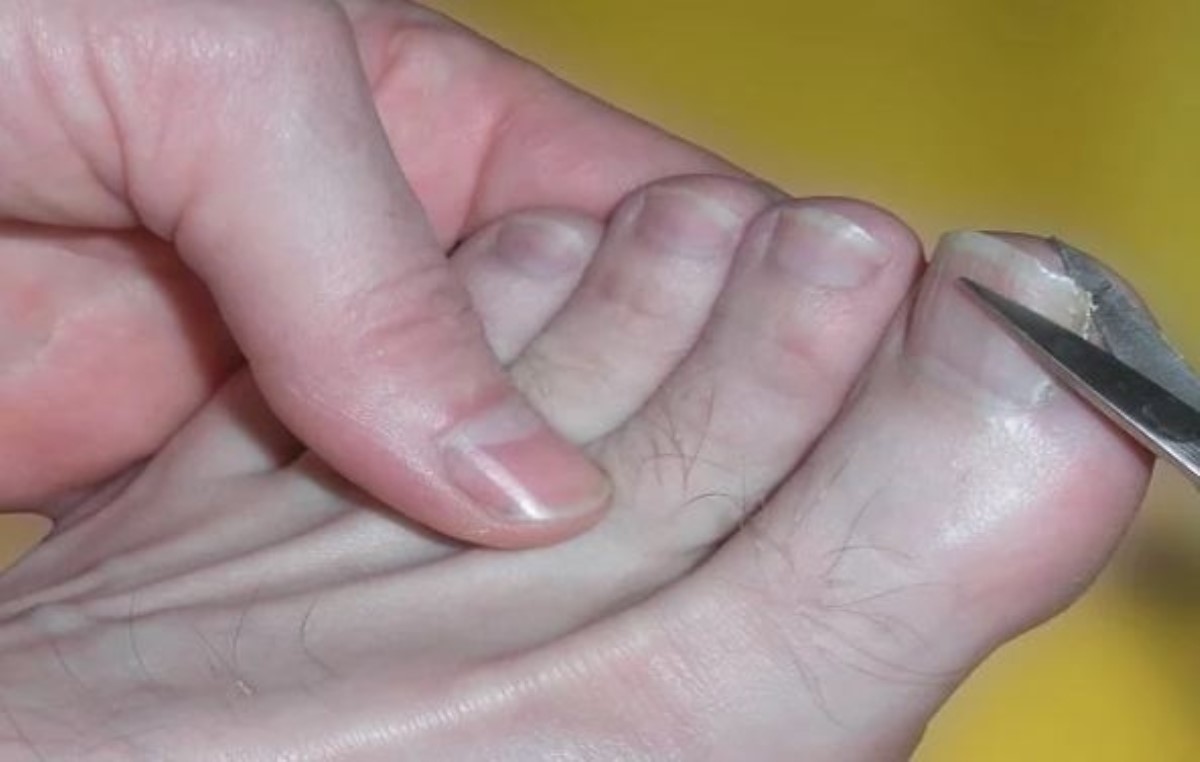 5 простых способов остричь жёсткие, утолщённые ногти на ногах