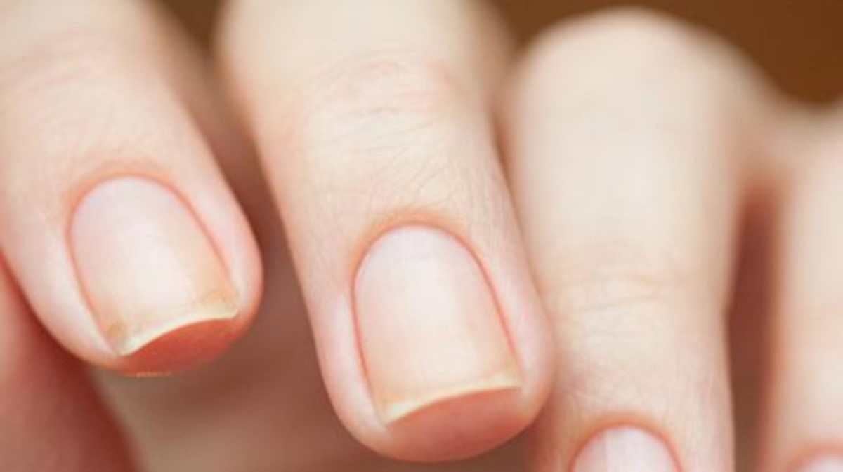 О каких болезнях могут сигнализировать ямочки на ногтях