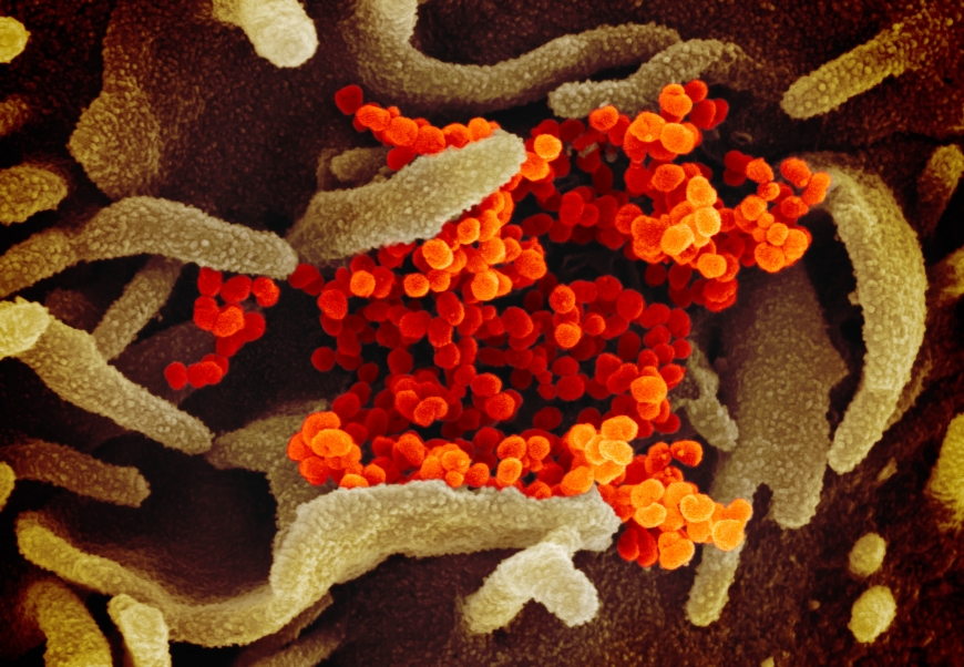 Коронавирус COVID-19: как выглядит смертельная болезнь под микроскопом. Фото