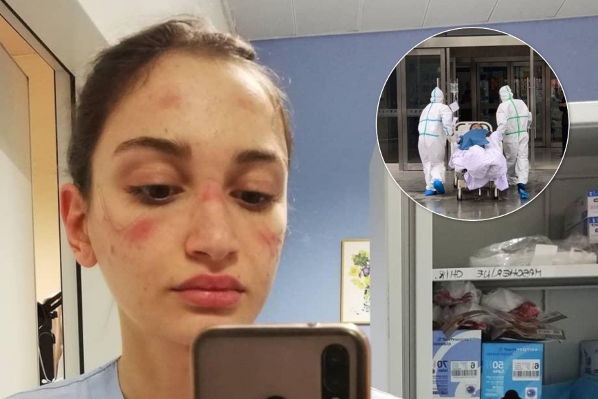 Атакующий коронавирус: медсестра показала свое лицо после многочасовой работы в маске