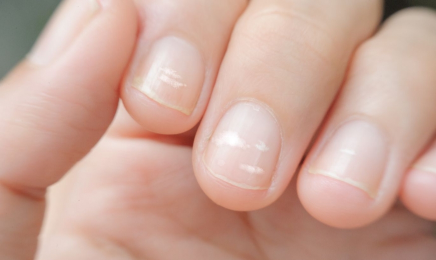 О каких проблемах могут предупредить белые полоски на ногтях