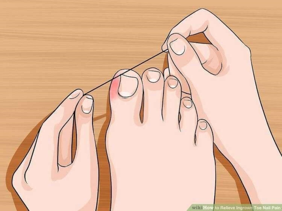 Врезаются ногти что делать. Правильная форма ногтей на ногах. Правильное подстригание ногтей на ногах. Правильная стрижка ногтей на ногах. Неправильное подстригание ногтей на ногах.