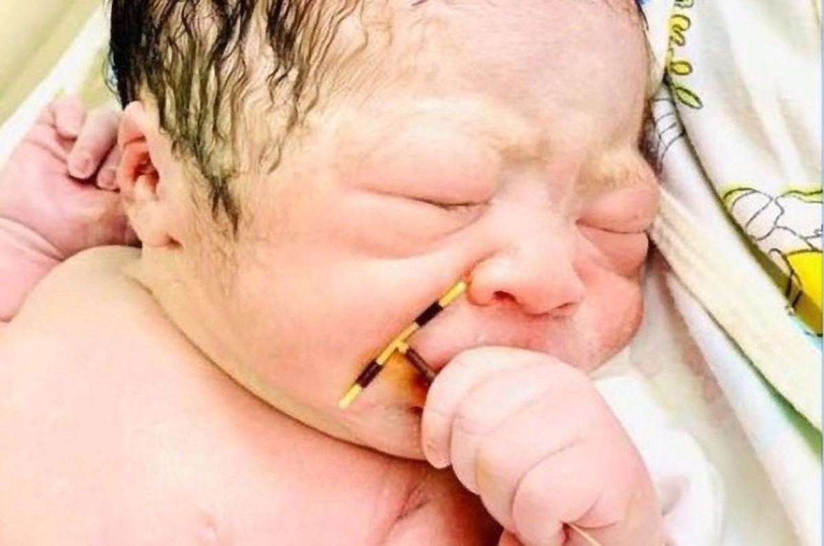 В ручке новорожденного обнаружили сломанную внутриматочную спираль