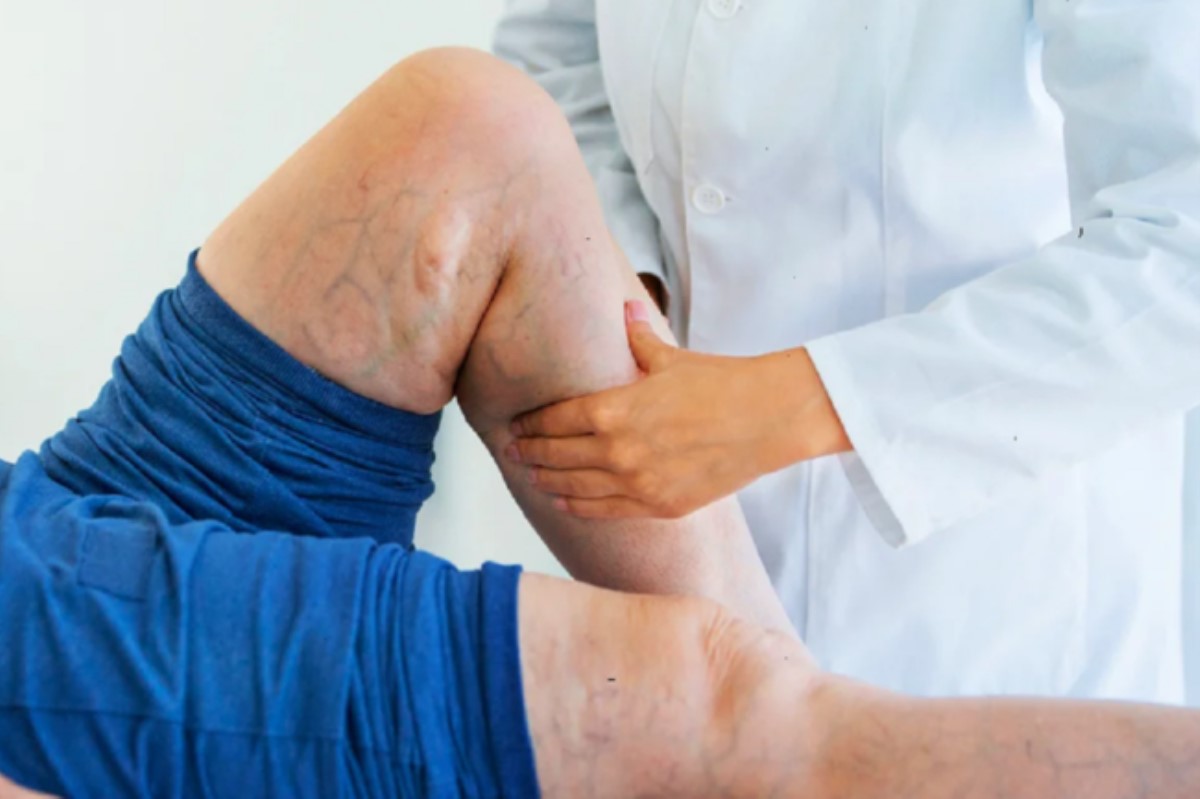 Названы симптомы, предупреждающие о тромбах в ногах