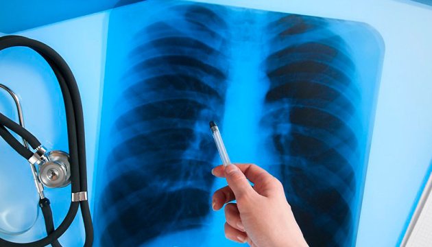 В июле в Украине зарегистрировали 1 530 новых случаев туберкулеза