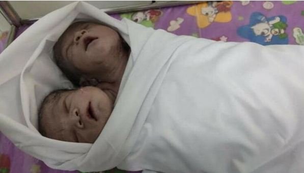 В Мьянме родился ребенок с двумя головами: малыш не является сиамским близнецом