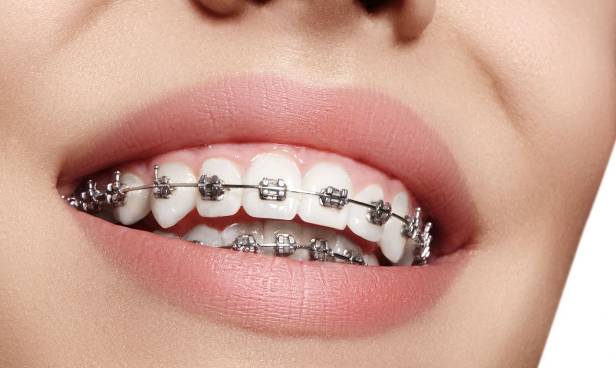 Как правильно питаться с брекетами: советы стоматолога