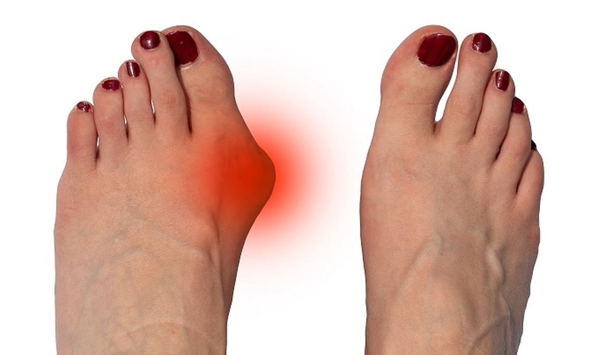Вылечить болезненную косточку на ноге: 8 народных способов