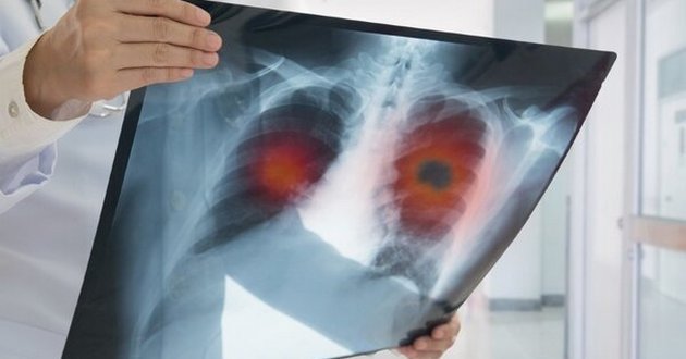 Как распознать пневмонию до похода к врачу: медики дали совет