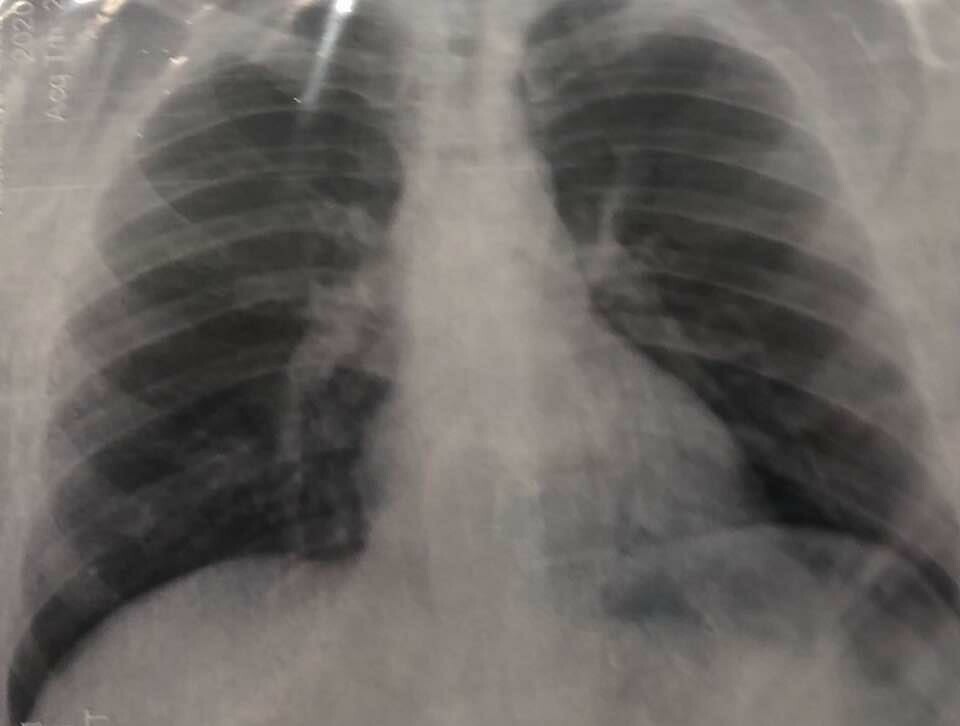 Рентген или УЗИ: врач рассказала, что лучше для диагностики пневмонии при COVID-19