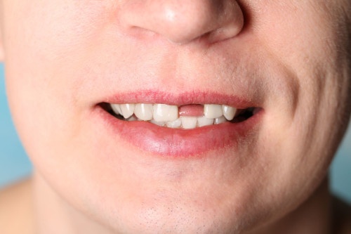 Переболевшие COVID-19 пациенты пожаловались на выпадение зубов
