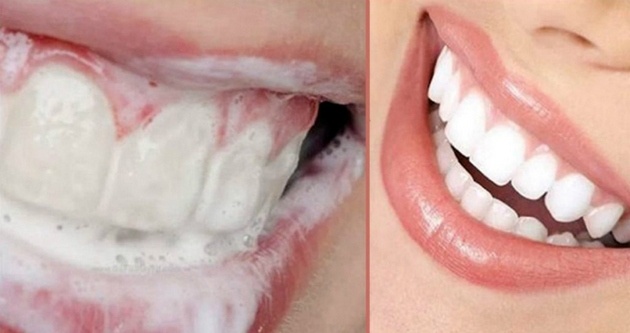 Самый простой метод безопасного отбеливания зубов: рецепт