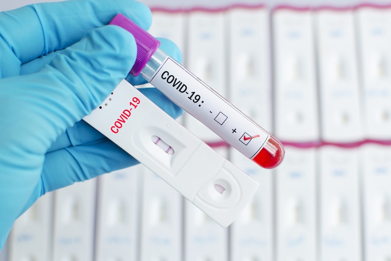 Украинцев будут бесплатно тестировать на антитела к коронавирусу SARS-CoV2