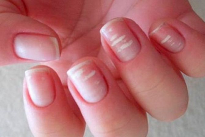 Белые пятна на ногтях: о чем предупреждает организм