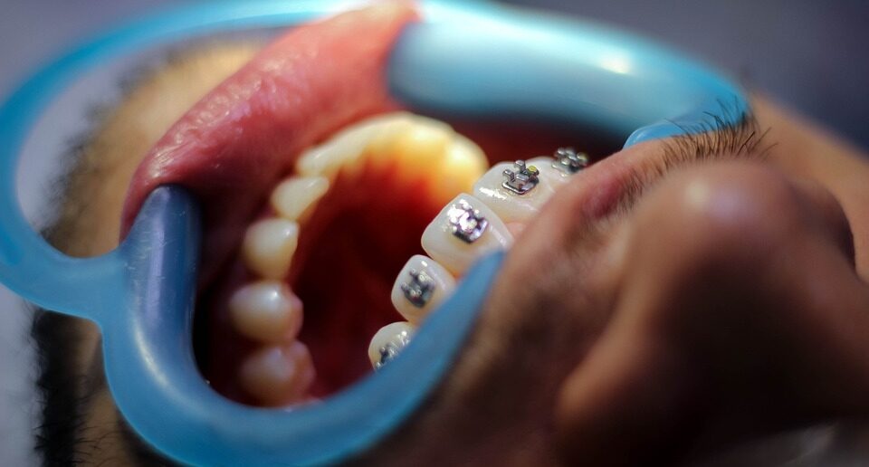 Женщина пробралась в кабинет стоматолога и вырвала пациенту 13 зубов