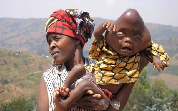 Родные просят избавиться от младенца: в Африке женщина родила ребенка с головой странной формы