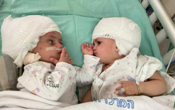 В Израиле провели первую в стране операцию по разделению сиамских близнецов