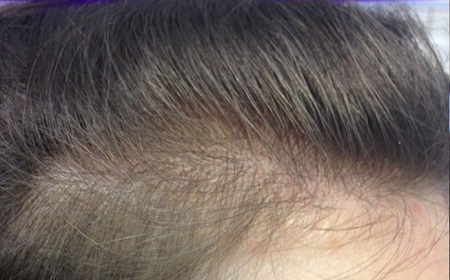 С чем может быть связано выпадение волос после COVID-19 - мнение врача