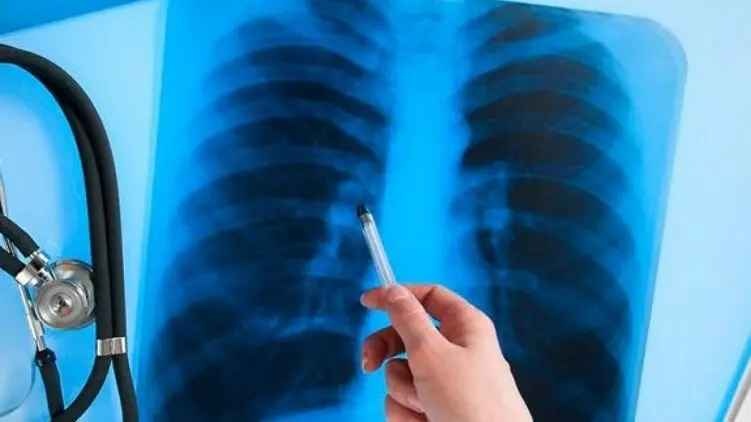 В Украине за месяц выявили более полутора тысяч случаев туберкулеза