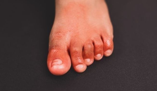 Похоже на обморожение ног: ученые обнаружили новый симптом COVID