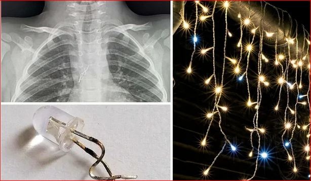 Во Львове врачи достали лампочку от гирлянды из трахеи 4-летнего ребенка