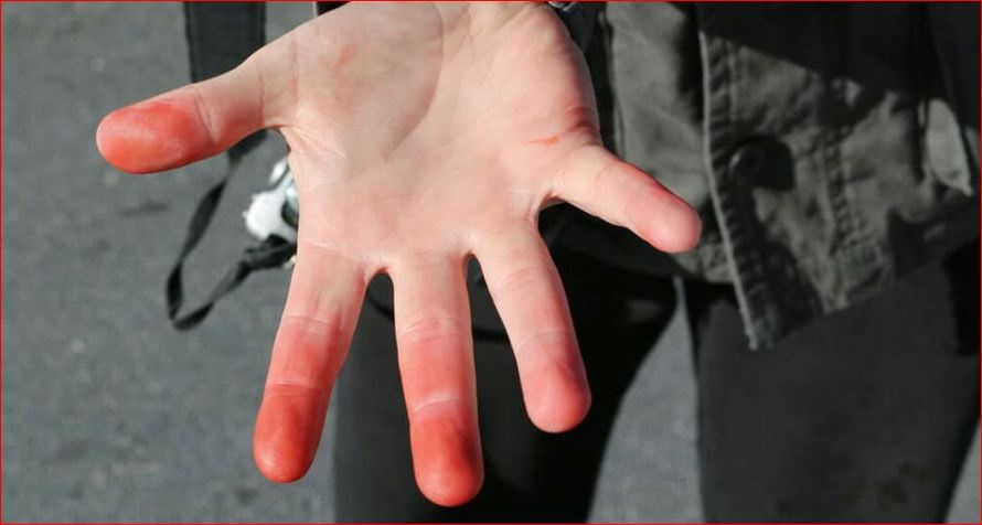 "Ковидные пальцы": назван опасный симптом COVID-19 у детей