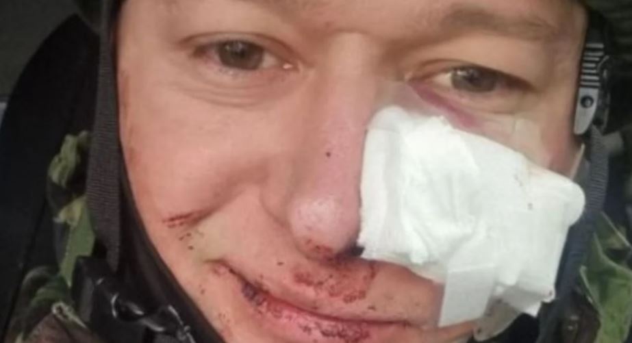 Осколки впились в лицо: лидер группы "Бумбокс" Андрей Хлывнюк ранен