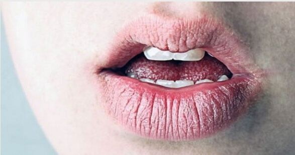 Потріскані та сухі губи: це симптоми хвороби чи неправильний догляд