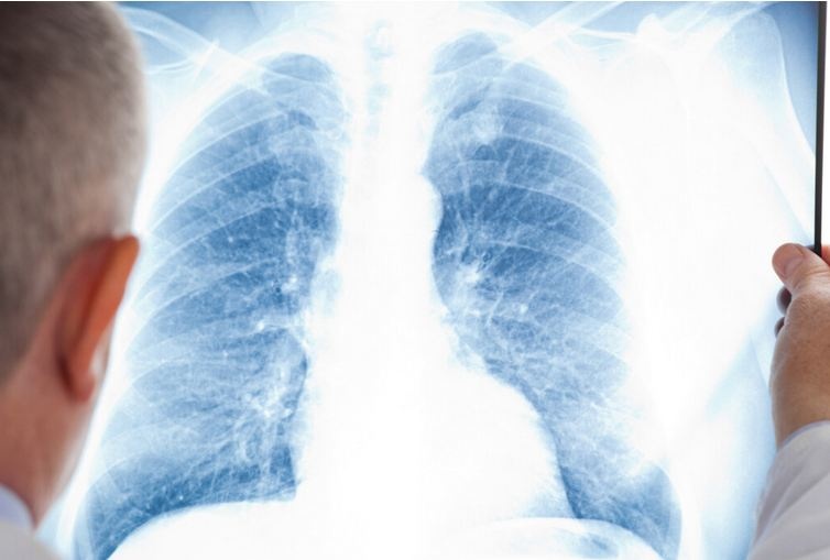 Ніколи не курила: жінка назвала перший симптом раку легенів, який проігнорувала