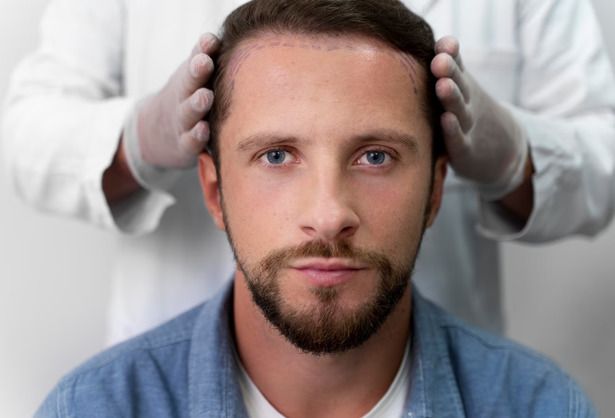Пересадка волос: влияет ли выбранная методика на итоговый результат