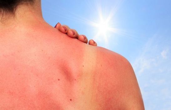Почему нельзя снимать обгоревшую на солнце кожу: дерматолог рассказала об опасности