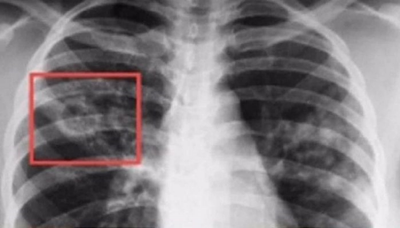Смертельный и бессимптомный штамм туберкулеза распространяется по Европе - The Mirror