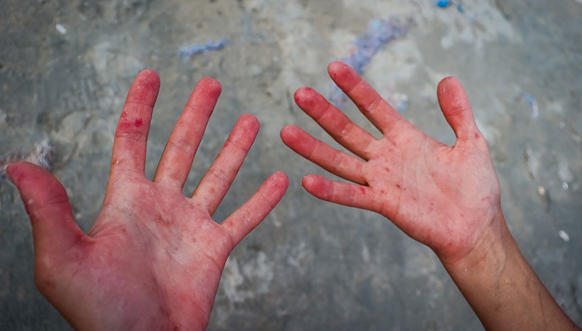 В Украине зафиксировали вспышку вируса Коксаки