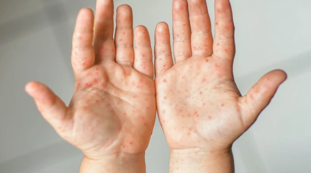 Что важно знать о вирусе Коксаки, который вызвал вспышку болезни в Киевской области