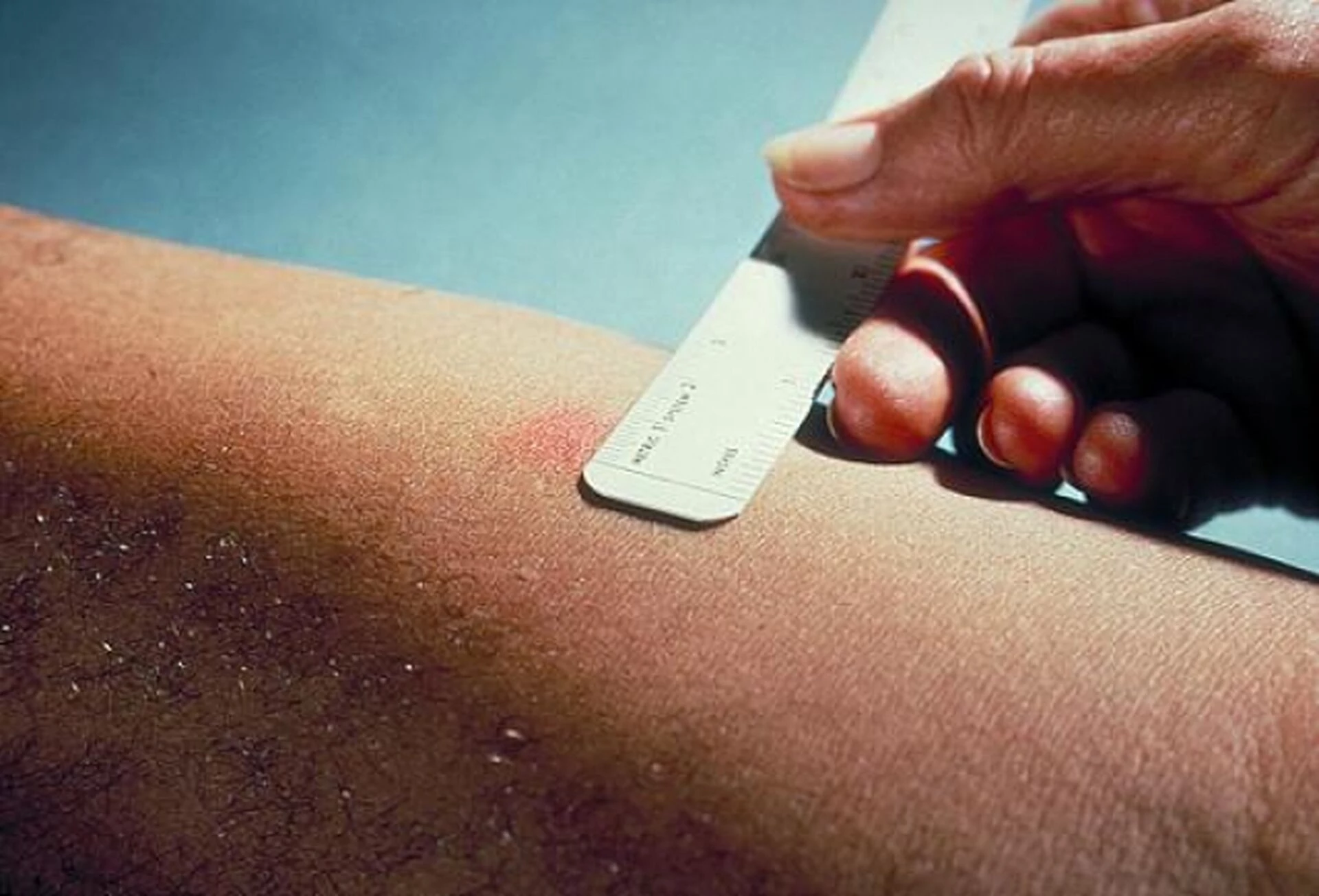 В Україні більше не буде проби Манту, впроваджуються нові методи діагностики туберкульозу